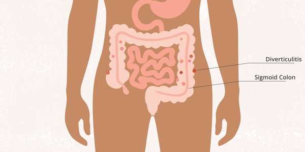 What Is Diverticulitis, And What Are The Symptoms